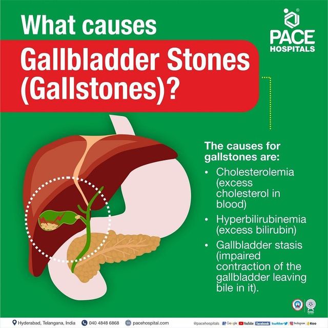 Gallstones, Gallbladder Stones – Symptoms, Causes, Complications