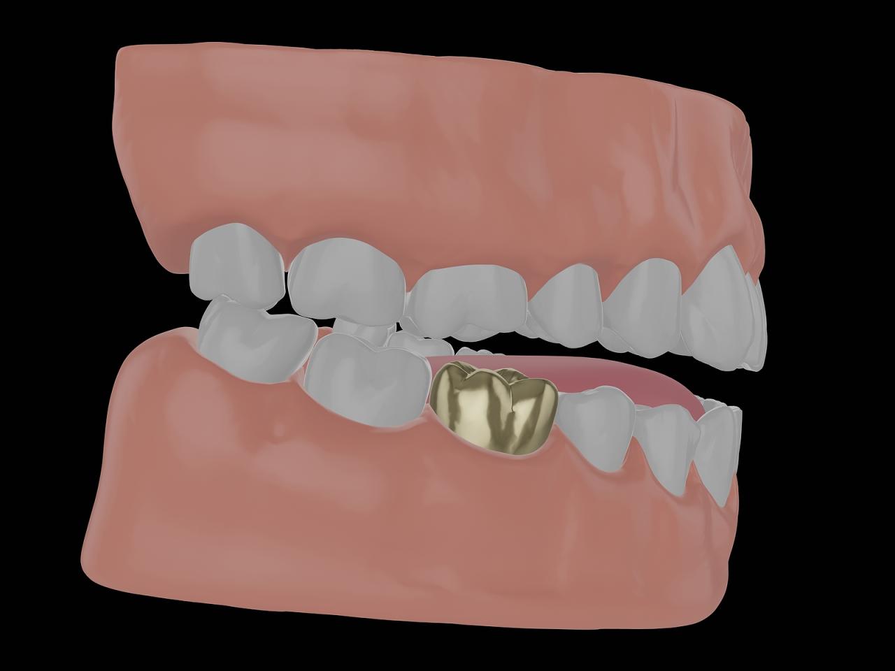 What Is A Gold Tooth Crown And What Are The Benefits?